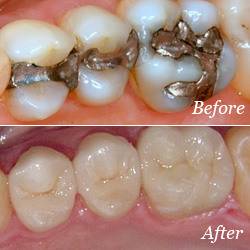 Crowns dentistry