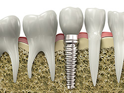 Dental implants are versatile