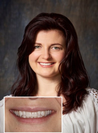 before-after-dental-veneers-01