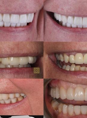 before-after-oral-restoration-crowns-02