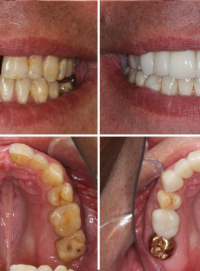 Jaw Re-Alignment, Dental Crowns and Implants, Full Mouth Rehabilitation