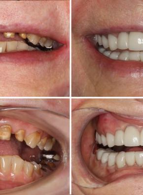 Porcelain Crown Restorations Bridges and Dental Implants