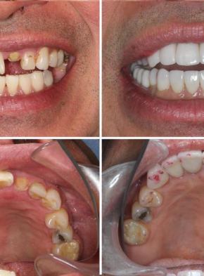 Teeth Replacement. Implants and Full Restoration