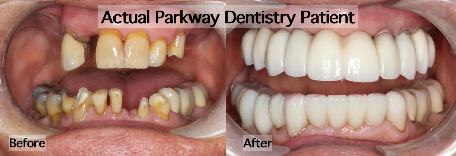 Before after TMJ rehabilitation treatment example