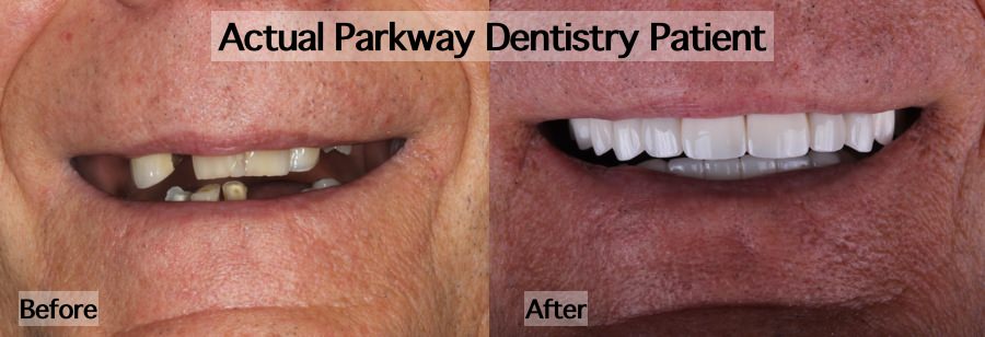 Before after mouth rehabilitation treatment example