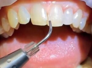 Dental laser treatment example