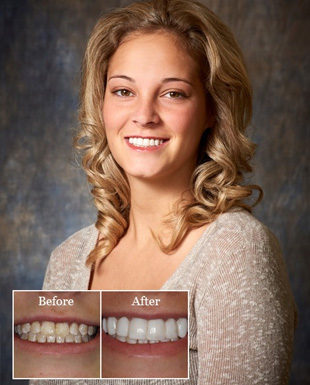 Teeth correction with Veneers