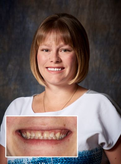 before-after-dental-braces-01