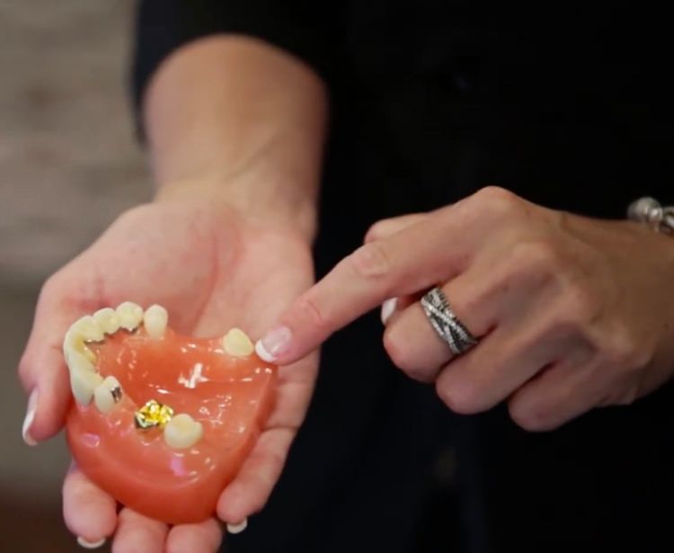 Dentist holding mouth mold with wisdom teeth