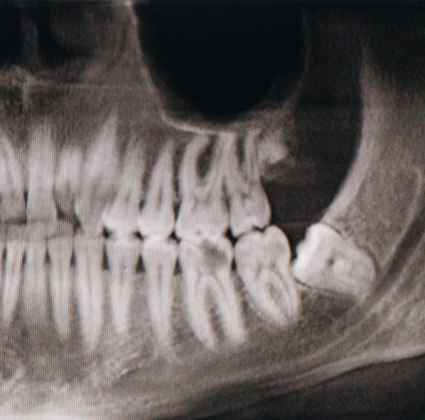 X-ray of bone resorption