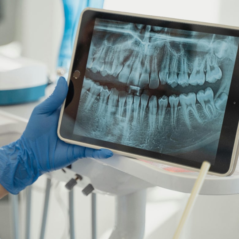 X-rays to check for dental implant need